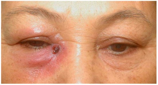 Periocular Infections