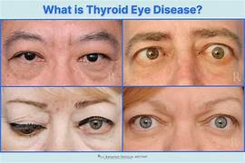 Thyroid Eye Disease